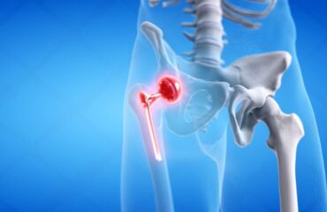 Best Hip Implants in Manufacturer and Exporter in India