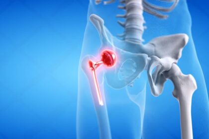 Best Hip Implants in Manufacturer and Exporter in India