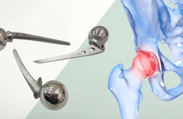 Hip Prosthesis and Hip Implants