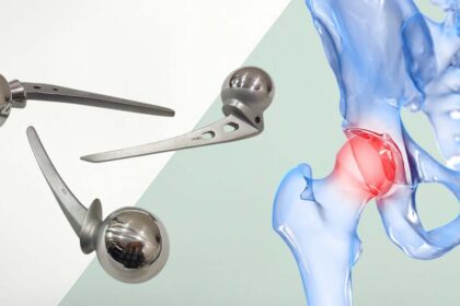 Hip Prosthesis and Hip Implants