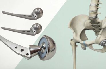 Hip Replacement System