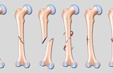 Causes of Bones Fractures