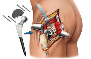Hip Replacement Surgery