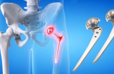 Hip Prosthesis - What are the Types, and Benefits