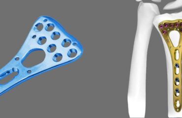 How does LCP Radius Fixed Angle Plate work, and what are its benefits