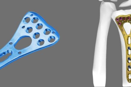 How does LCP Radius Fixed Angle Plate work, and what are its benefits