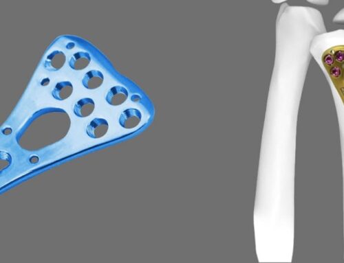 How does LCP Radius Fixed Angle Plate work, and what are its benefits?