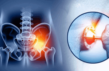 Total Hip Replacement - A Comprehensive Guide