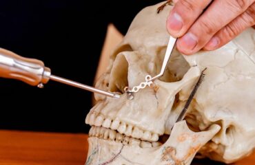 Maxillofacial Implant Surgery