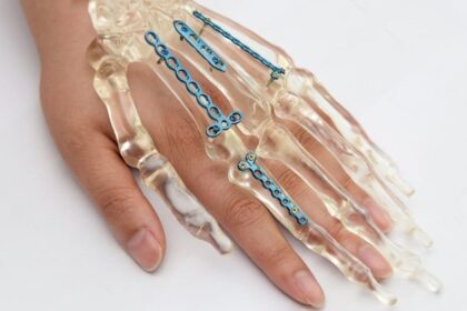 Mini Fragment Implants