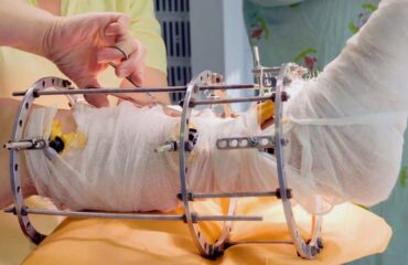 External Fixators in Orthopedics