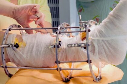 External Fixators in Orthopedics
