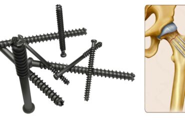 A Guide to Cannulated Screws