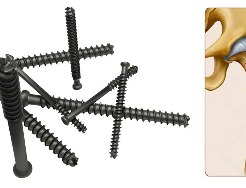 An Overview of Cannulated Screws: Uses and Types - HEMC Ortho