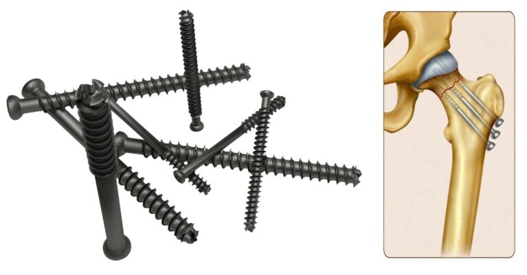 A Guide to Cannulated Screws