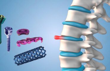 Spine Implants