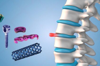 Spine Implants