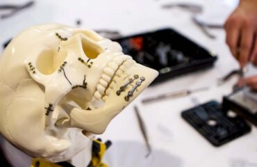 Cranio-Maxillofacial Implants & Screws