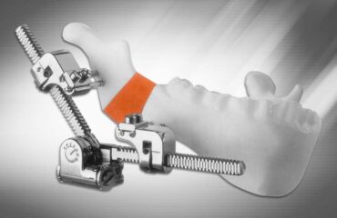 Multi-Guided Mandibular Distractor