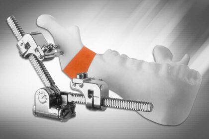 Multi-Guided Mandibular Distractor