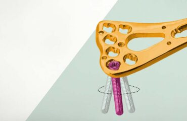 A Guide to Variable Angle Locking Plate Systems