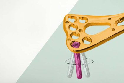 A Guide to Variable Angle Locking Plate Systems