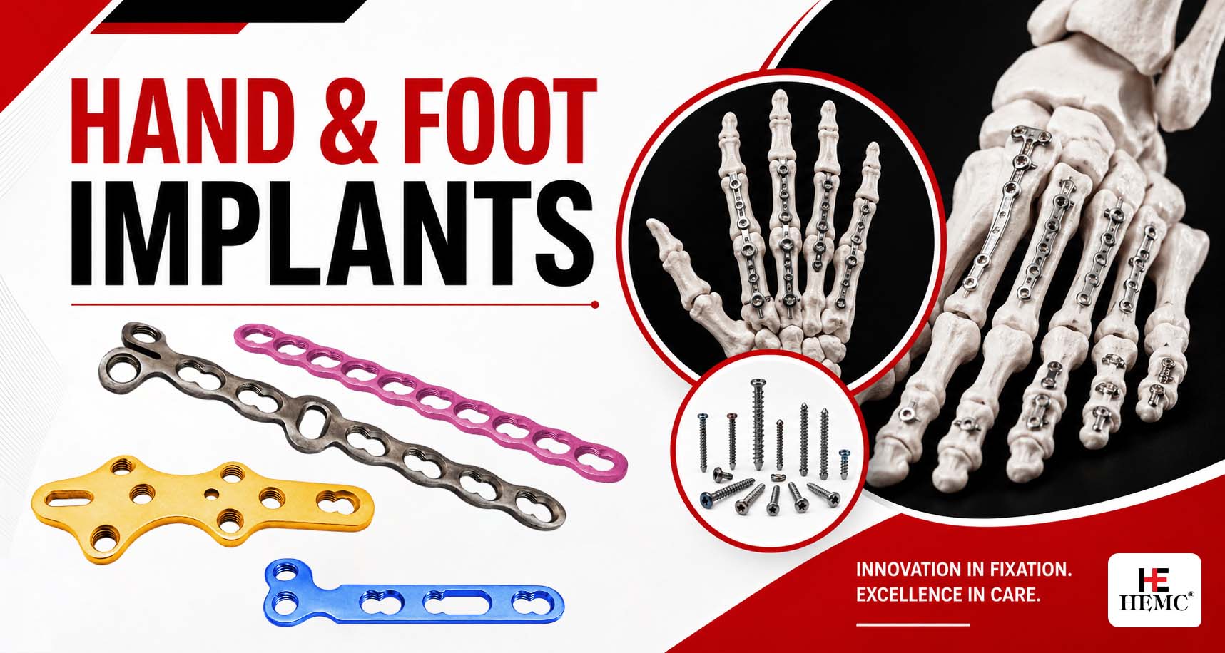 Hand and Foot Implants- Advanced Solutions for Orthopaedic Trauma Hand and Foot Implants