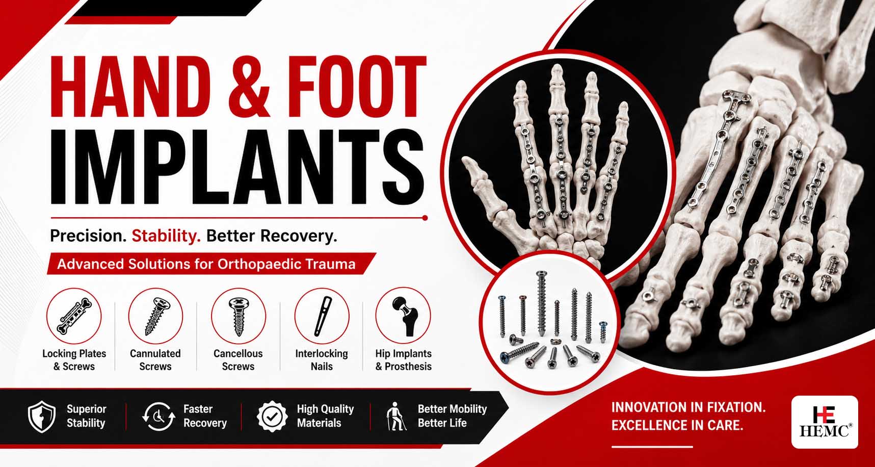 Hand and Foot Implants