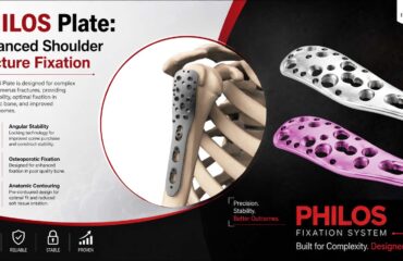 PHILOS Plate - Advanced Shoulder Fracture Fixation PHILOS Plate