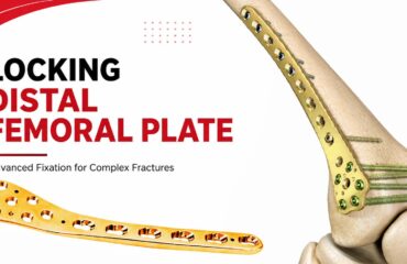 Locking Distal Femoral Plate: Features & Benefits Locking Distal Femoral Plate